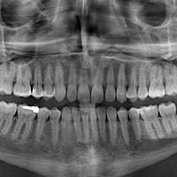Röntgenaufnahmen der Zähne