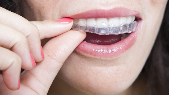 Vier Schritte zur Reparatur beschädigter Brackets